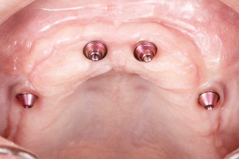 Caso clínico implantodontia