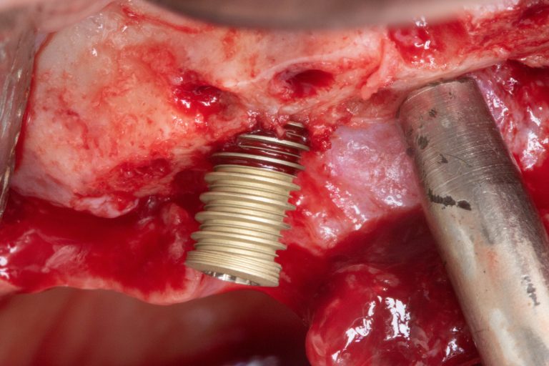 Caso clínico implantodontia