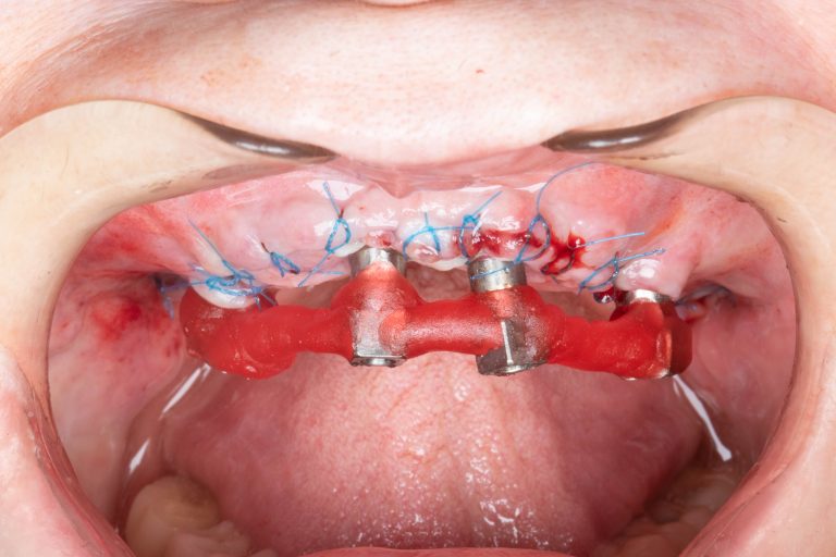 Caso clínico implantodontia