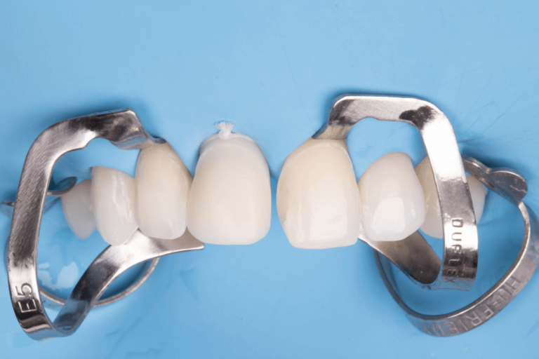 Caso clínico prótese