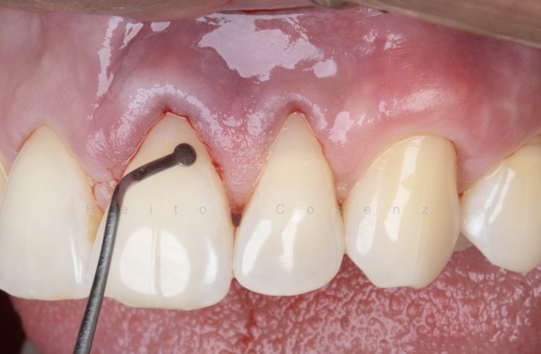 Caso clínico periodontia