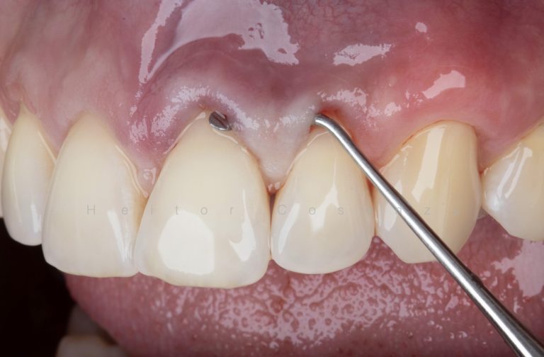 Caso clínico periodontia