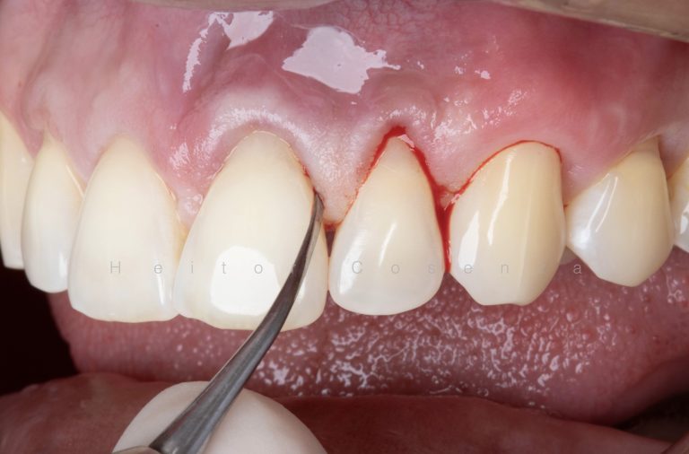 Caso clínico periodontia