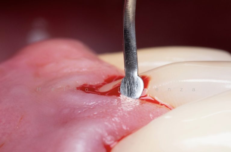 Caso clínico periodontia