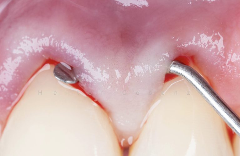 Caso clínico periodontia