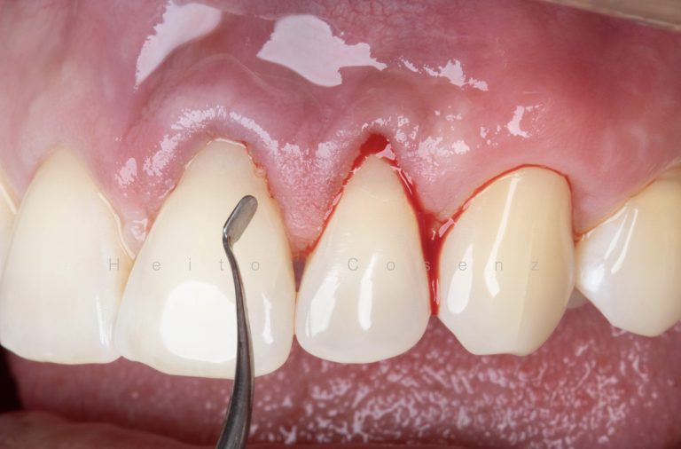 Caso clínico periodontia