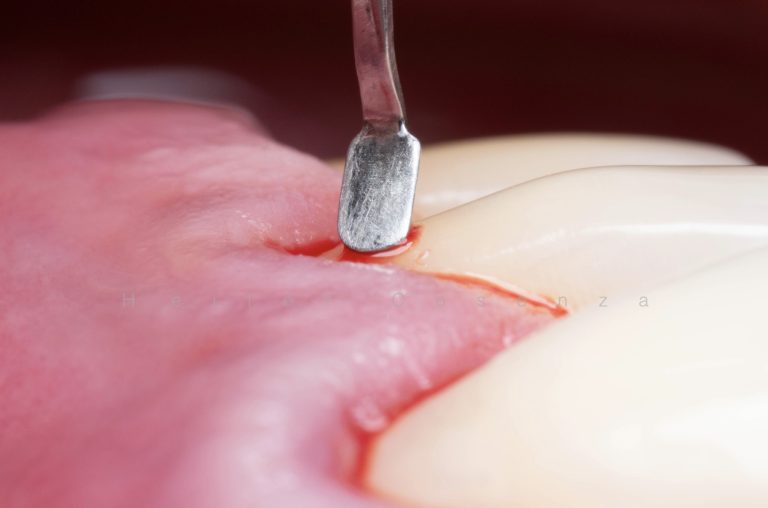 Caso clínico periodontia