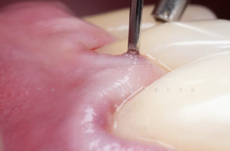 Caso clínico periodontia