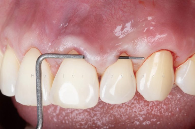 Caso clínico periodontia