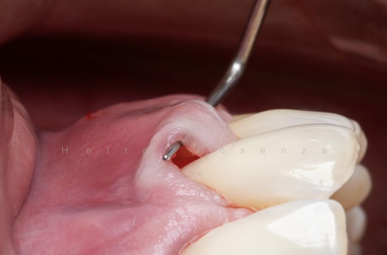 Caso clínico periodontia