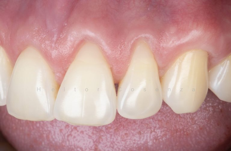 Caso clínico periodontia